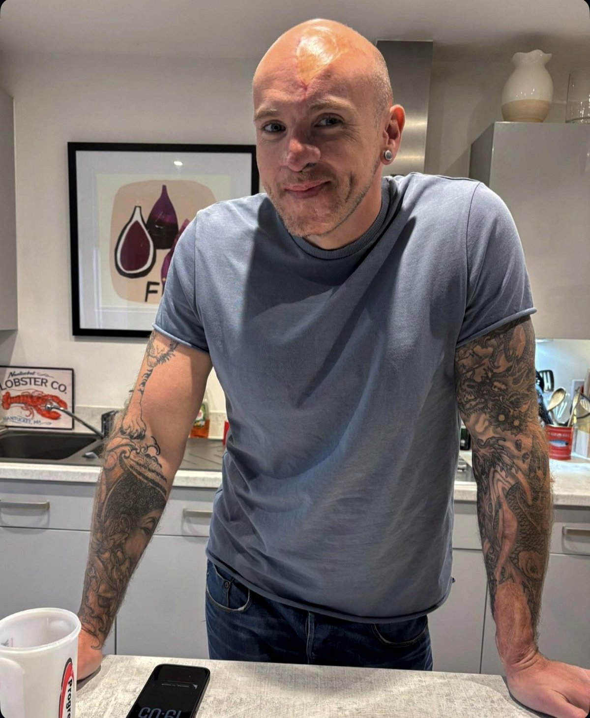 From Struggle to Strength: Celebrating My Surgery Milestone