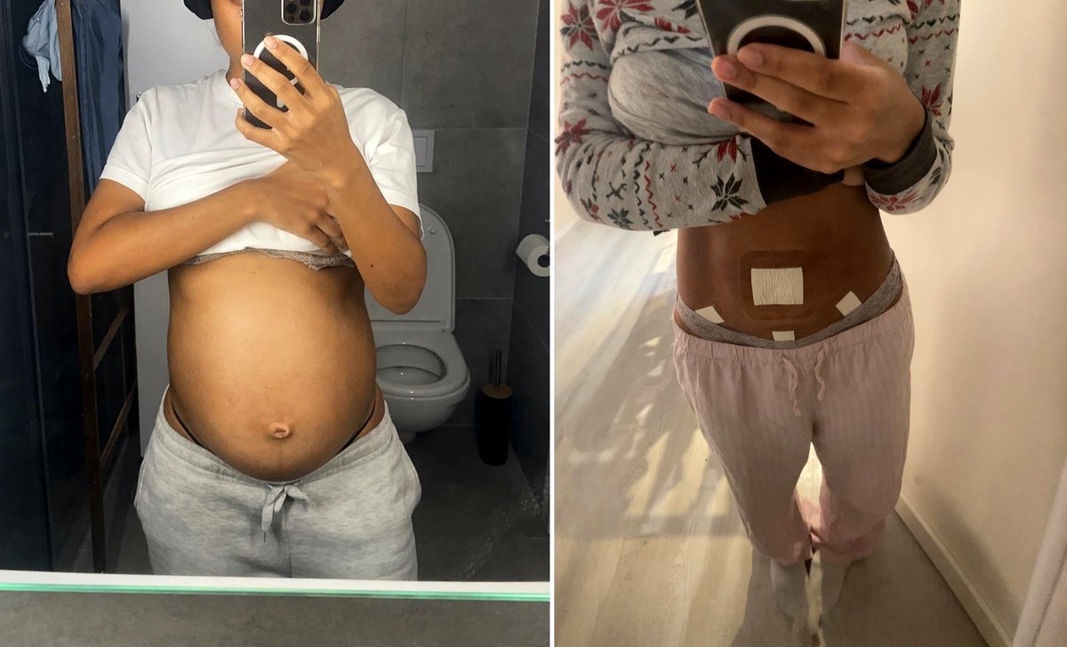 How I battled and triumphed over an 8 kg cyst