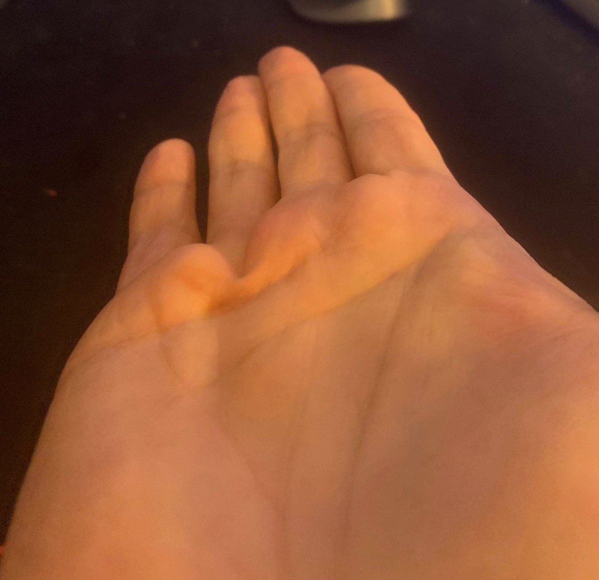 Throughout the years, I've noticed an unusual line forming beneath my ring finger.