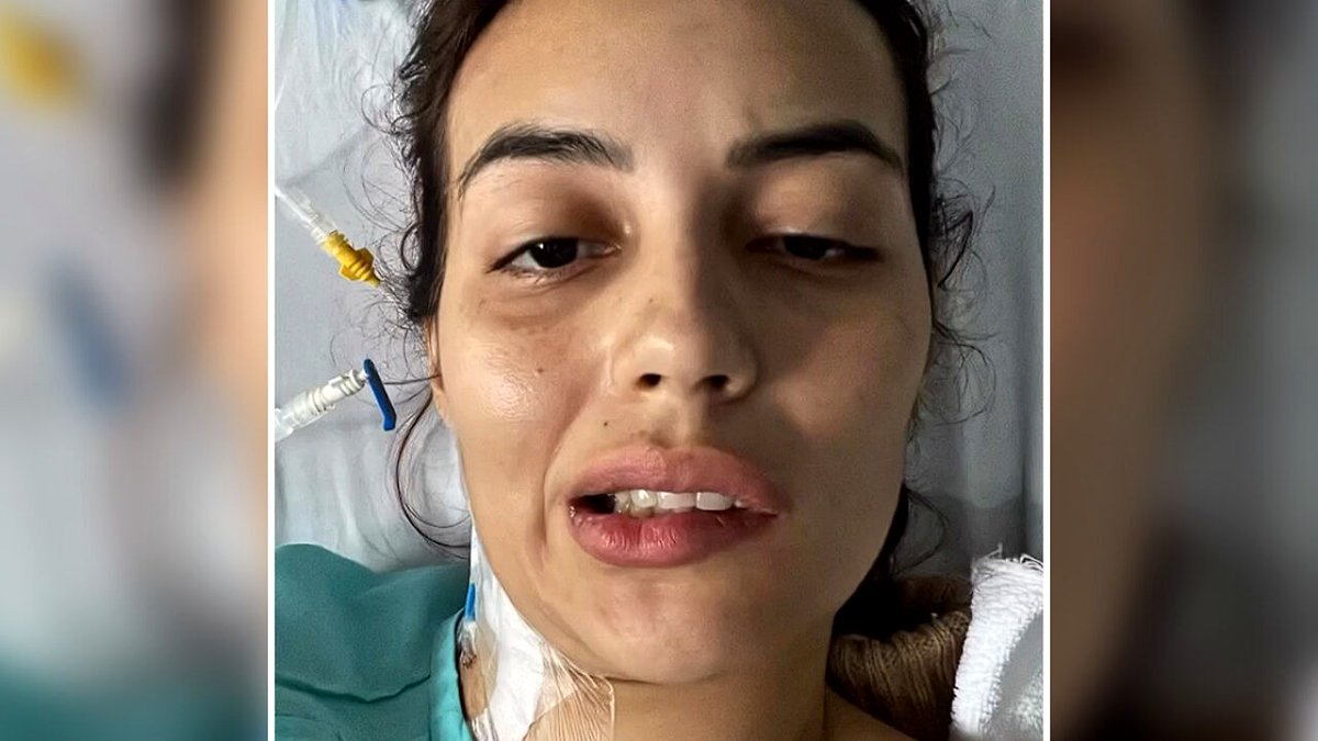 Teen Influencer Suffers Facial Paralysis After 23 Days in ICU Due to Sushi Consumption, Doctors Warn of Dangers
